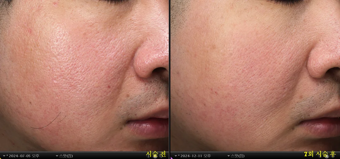 Cheek pores — before & after 7 sessions comparison photo