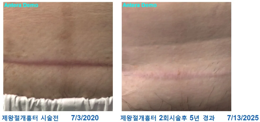C-section scar — before & after comparison photo