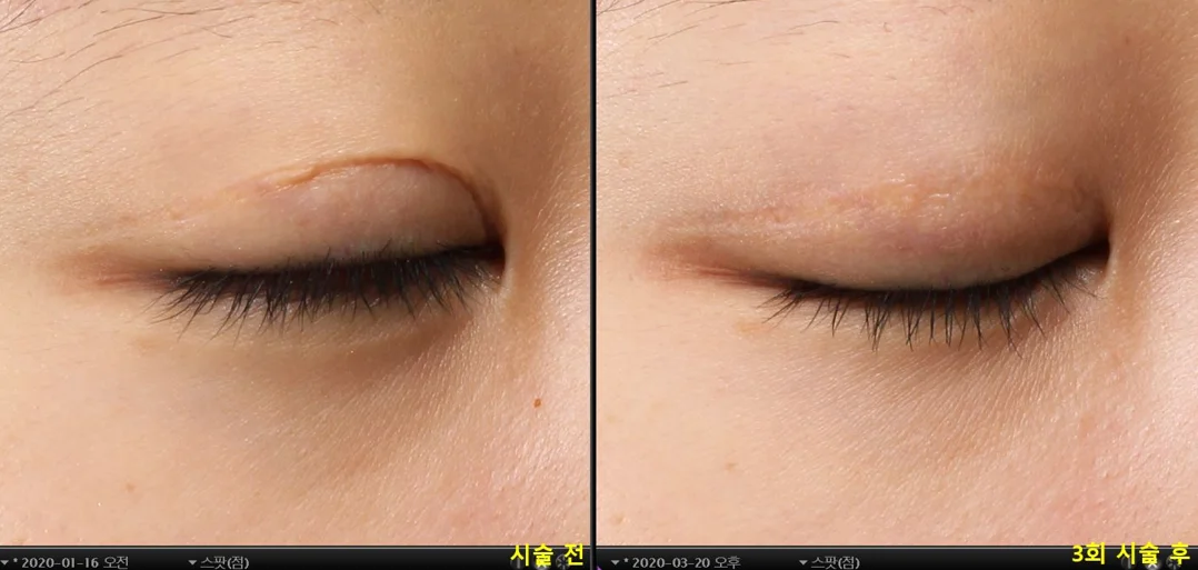 Double-eyelid surgery scar — before & after 3 sessions comparison photo