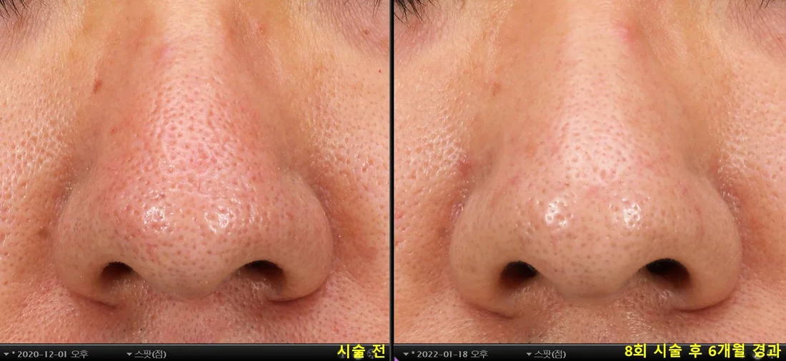 Nose pores — before & after 8 sessions comparison photo