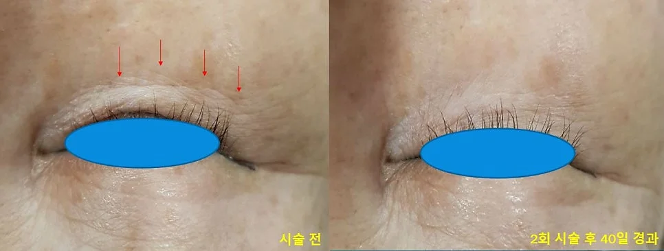 Under-eye lines — before & after 2 sessions comparison photo